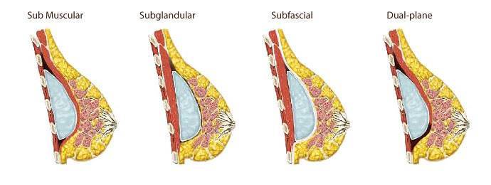 Breast implant placement Subglandular Subfascial Sub Muscular and Dual-plane