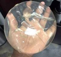 Saline filled breast implants